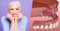 Full Mouth Implants in Houston TX | Affordable Dental Implants Houston