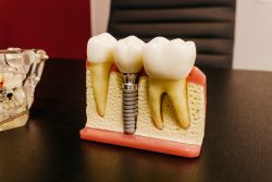 Dental Implants in Midtown Houston TX | Dental Implant Surgery Houston, TX | Midtown Dental