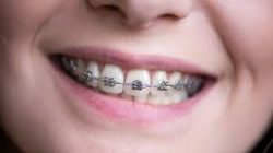 Metal Braces Cost