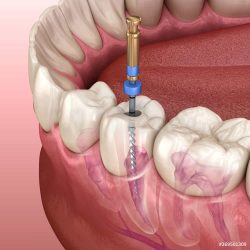 Dental Health and Root Canals