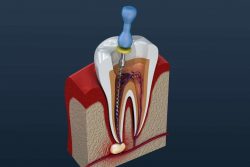 Root Canal Safety Houston TX, Medical Center