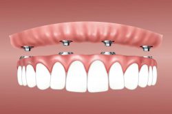 Dental Implants : Best Invisalign Dentist in Houston