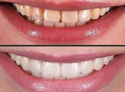 Mouth Scaling & Cleaning, Mouth Polishing, Teeth Whitening