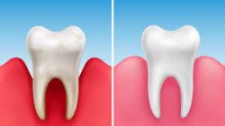 Emergency Root Canal Dentist Near Me | Root Canal Treatment After Care