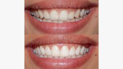 Gingivectomy Near Me | Gingivectomy Before and After