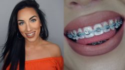 Braces power chain colors | Power Chain Braces: Benefits, Side Effects,