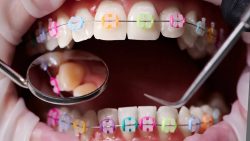 Affordable Braces Near Me | Cheap Braces: Affordable Orthodontic Options for Low-Income