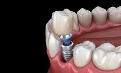 Same-Day Dental Implants: Cost, Procedure, and Recovery | Same Day Dental Implants Near Me