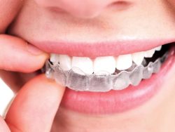 Invisalign Clear Braces in Houston | Invisalign Clear Braces in Houston