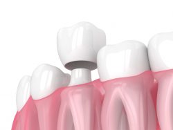 Dental Crowns Near Me | Porcelain Crowns Houston TX