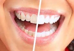 Teeth Whitening, Houston TX 77024 | Teeth Bleaching Dentist