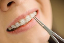 How Much Does Invisalign Cost?