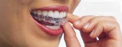 Orthodontic / Braces Treatment – Average Cost of Braces: Age, Type, Insurance, Other Factors