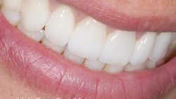 Single Front Tooth Crown | Porcelain Crown and Bridges Before And After