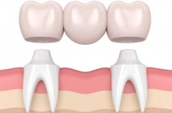 Maryland Bridge Dental | Cantilever Bridge Dental