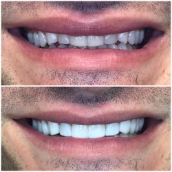 Teeth Bonding Before And After Procedure