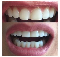 What is composite bonding teeth?