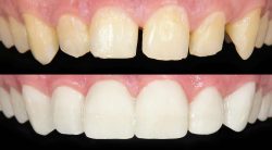 Bonding Teeth Before And After Procedure