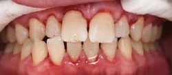 Teeth Cleaning Before And After | Deep Teeth Cleaning Near Me