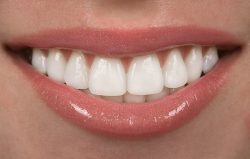 Straight Teeth Veneers