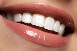 Traditional Veneers in Houston