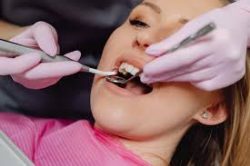 Wisdom Tooth Extraction in Sunny Isles