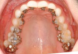 Teeth Braces Cost, Procedure, Types