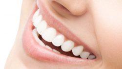 Professional Teeth Whitening Houston