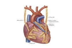 Bypass Surgery by Dr. Sujay Shad