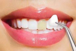 Affordable Porcelain Veneers Near Me