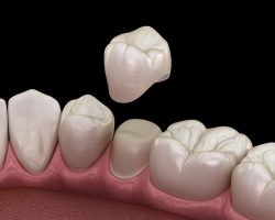 Affordable Dental Crowns Near Me