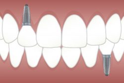 Affordable Dental Implants in Houston TX