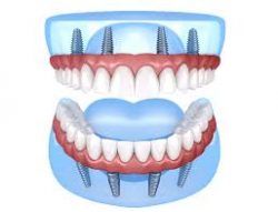 Affordable Dental Implants Near Me