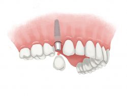 Affordable Teeth Implants in Houston TX