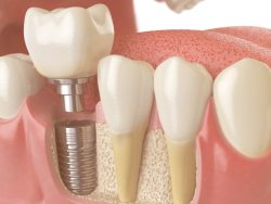 Bone Graft Dental in Houston TX