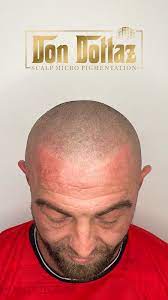 Scalp Micropigmentation sheffield