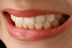 Average Cost of Veneers