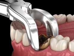 Impacted Wisdom Teeth Extraction Near Me | Extract Wisdom Teeth