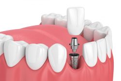 Why You Should Choose Dental Implants