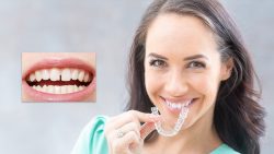 Fix Front Teeth Gap in Houston