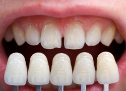 Veneers For Gap Teeth | Fix Front Teeth Gap in Houston