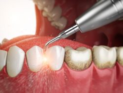 Gingivectomy Dentist In Houston TX