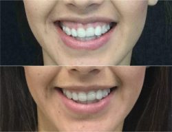 Gummy Smile Surgery Near Me