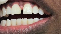 Teeth Gap Fillings Houston, TX – Best Dental