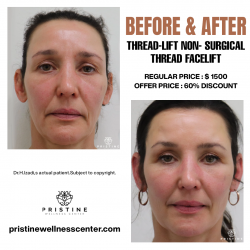 Non-Surgical Facelift Threading