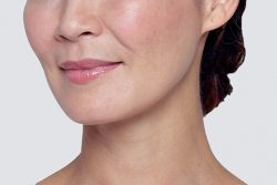 Restylane Cheek Filler: What Is It?