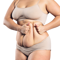 Tummy Tuck Prices In South Africa