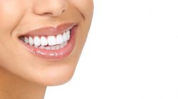 What Is the Cost of Full-Mouth Porcelain Veneers?