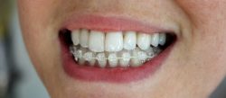 Six Month Smiles Problems |The Dangers of “Six Month Smiles”