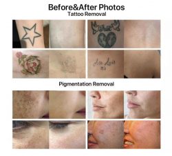 Pico laser treatment